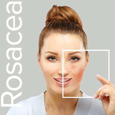 Rosacea