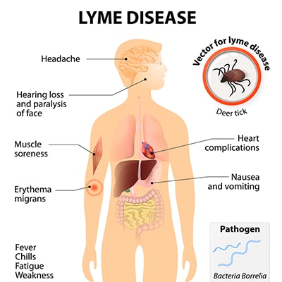 Lyme disease symptoms